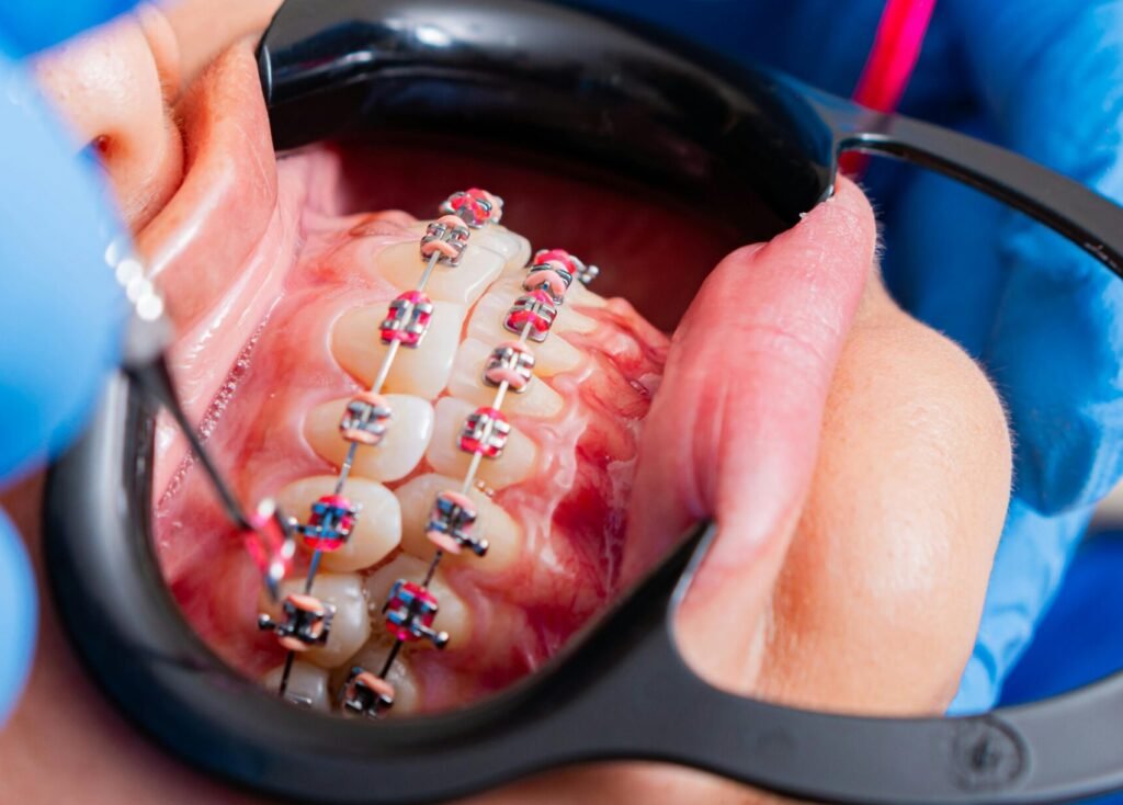 Close-up of dental braces being examined by dentist using tools with gloves.