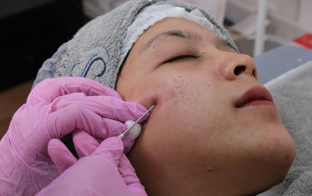 Close-up of a person undergoing microneedling skincare treatment indoors.